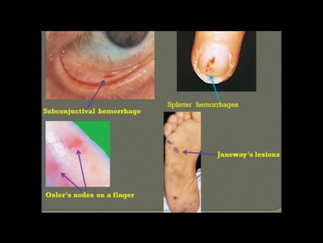 Ein Fall von Endokarditis: Klinische Manifestationen, Diagnose und Echokardiographie