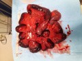Viszeralvenenthrombose