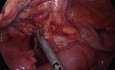 Laparoskopische Ileozökalresektion bei Morbus Crohn unter Einsatz von ICG und Fluoreszenz