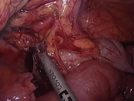 Laparoskopische Ileozökalresektion bei Morbus Crohn unter Einsatz von ICG und Fluoreszenz