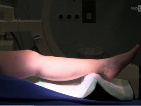 OrthoProcedure - Hohe Tibia-Osteotomie