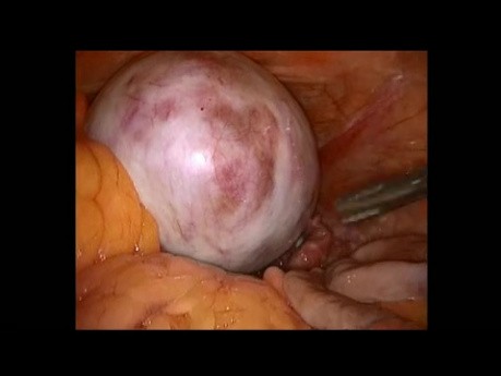 Adnexektomie des ovariellen Teratoms