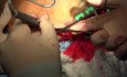Chirurgische Therapie bei Frakturen des Schädeldaches, Os zygomaticum und Os mandibulare