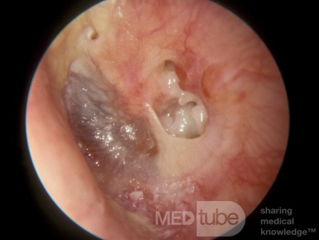 Trommelfellperforation mit Cholesteatom