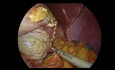 Laparoskopische Resektion von Magen-GIST (gastrointestinaler Stromatumor)