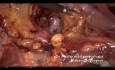 Pelvine Lymphadenektomie