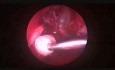 Glomangiopericytoma, seltener Tumor