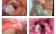 Akute Epiglottitis mit Abszess