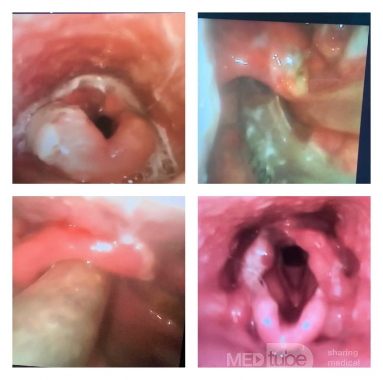 Akute Epiglottitis mit Abszess