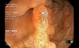 Familiäre adenomatöse Polyposis (FAP)