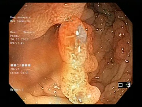 Familiäre adenomatöse Polyposis (FAP)