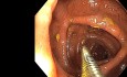 Endoskopische Polypektomie eines Riesenpolypen – Colon transversum