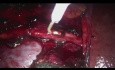 Retroperitoneale Dissektion des rechten Lymphknotens