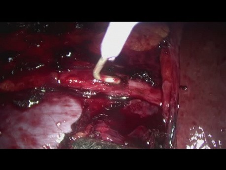 Retroperitoneale Dissektion des rechten Lymphknotens