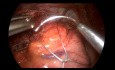 Redo-Chirurgie: Fundoplikatio nach Nissen mit Platzierung eines langsam resorbierbaren Hiatalnetzes