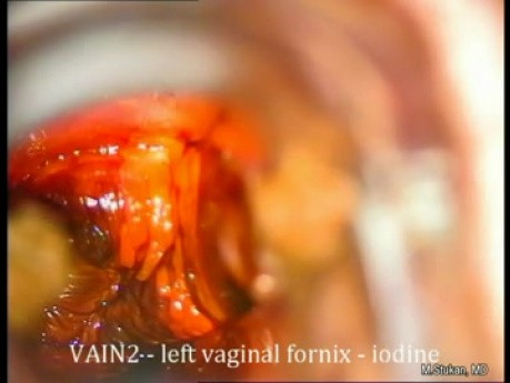 Kolposkopie der Vagina