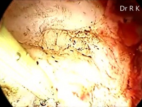 Hysteroskopische Myomektomie