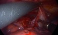 Mediastinale bronchogene Zyste