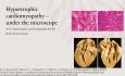 Echokardiographie und multimodale kardiovaskuläre Bildgebung bei hypertropher Kardiomyopathie - 2022 Update