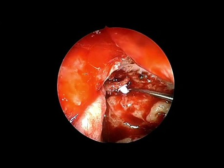 Mastoidhöhlen-Obliteration und Rekonstruktion der Gehörgangswand mit Lappen der Arteria auricularis posterior (PAA)