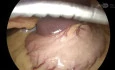 Laparoskopische Rekonstruktion einer Hiatushernie mit Toupet-Fundoplikatio