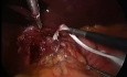 Laparoskopische Chirurgie von der Hiatushernie