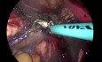 vNOTES Hysterektomie bei Endometriumhyperplasie