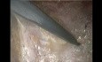 Laparoskopische Enhanced-View Totally Extraperitoneal (eTEP) Versorgung der ventralen Hernie