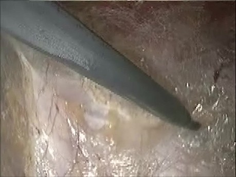 Laparoskopische Enhanced-View Totally Extraperitoneal (eTEP) Versorgung der ventralen Hernie