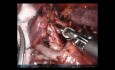 Roboter-Trisegmentektomie des linken Oberlappens