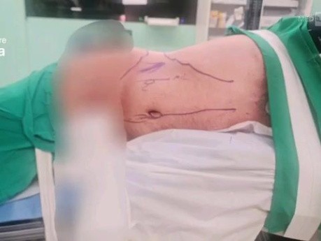 Laparoskopische rechtsseitige Adrenalektomie mit Lymphadenektomie bei 5 × 5 cm großer Nebennierenraumforderung