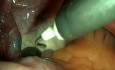 Operative Laparoskopie bei Polyzystischem Ovar-Syndrom