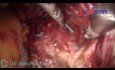 Laparoskopische Hysterektomie mit vorherigem Kaiserschnitt