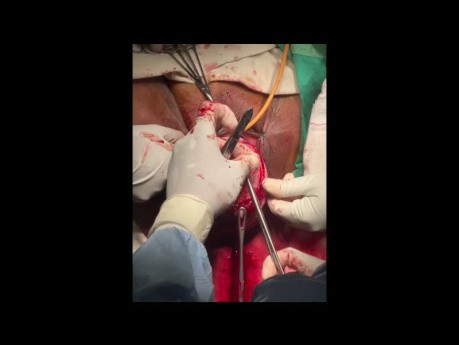 Lefortes Operation