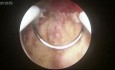 Hysteroskopische Resektion der Endometriumhyperplasie