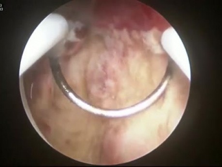 Hysteroskopische Resektion der Endometriumhyperplasie