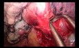 Anatomische Trisegmentektomie oben links, durchgeführt von Uniportal VATS (unbearbeitetes Video)