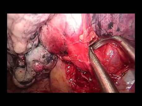 Anatomische Trisegmentektomie oben links, durchgeführt von Uniportal VATS (unbearbeitetes Video)