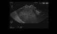 Endoskopischer Ultraschall einer Pankreasschwanz-Masse mit Sekundärleber
