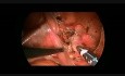 Laparoskopische Resektion der Urachuszyste bei einem Kind