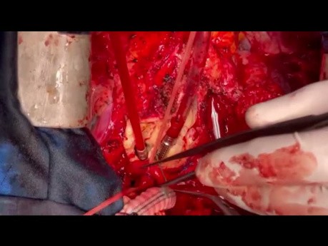 Die Prinzipien der erneuten Aortenchirurgie von A bis Z