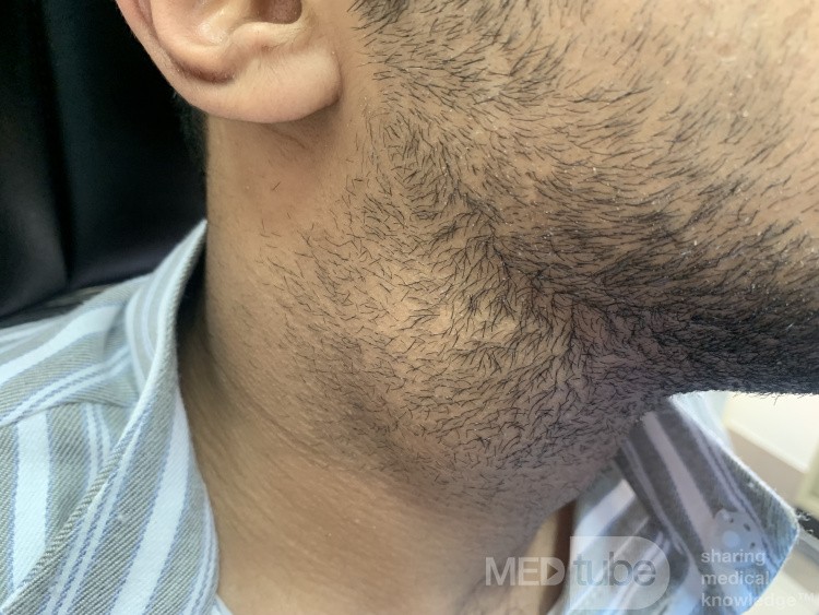 Infizierte gemischte Laryngozele rechts