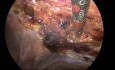 Hernienchirurgie nach der IPOM-Methode