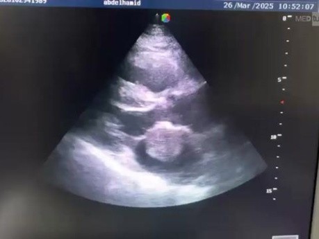 Echokardiographischer Nachweis eines Myxoms des linken Vorhofs