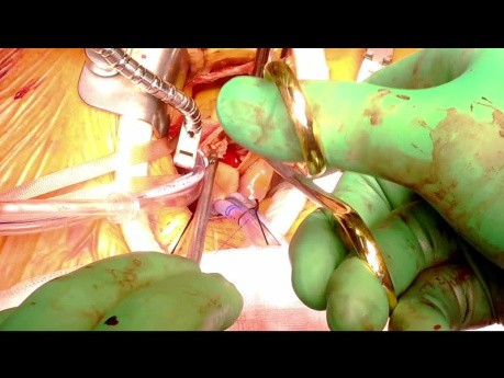 Aortenklappenersatz über eine rechte anteriore Thorakotomie. Avalus-Prothese