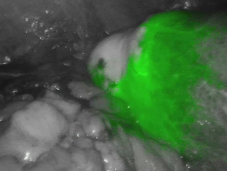 Anastomose nach Hemikolektomie rechts - ICG-Perfusionstest
