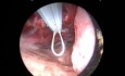Mikrohysteroskopie. Doppelte Gebärmutter. Resektion von Uteruspolypen