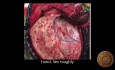 Fossa Temporalis