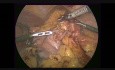 Laparoskopische subtotale D2-Gastrektomie bei einem Magenkarzinom