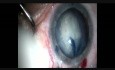 Die Rolle des ovalen Einschnitts bei der Subluxationslinse